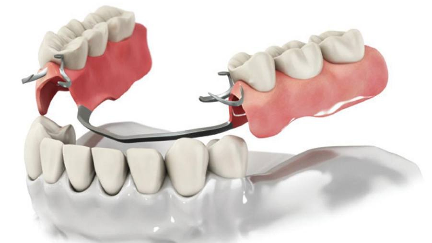 byugelnoe-protezzirovanie-po-slepku-zubov