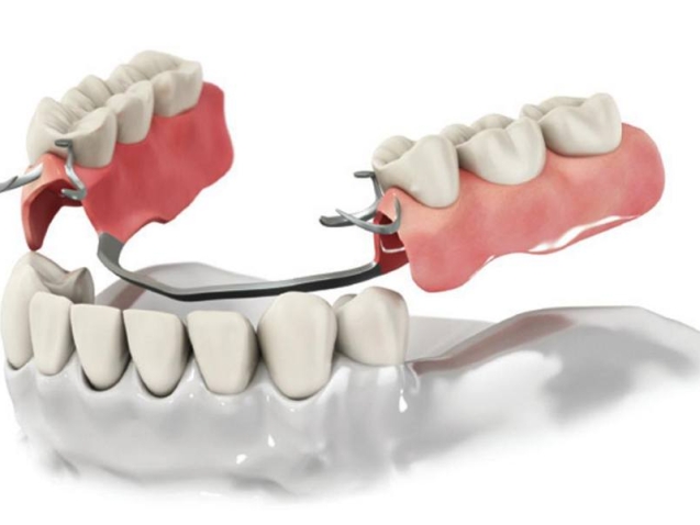 byugelnoe-protezzirovanie-po-slepku-zubov
