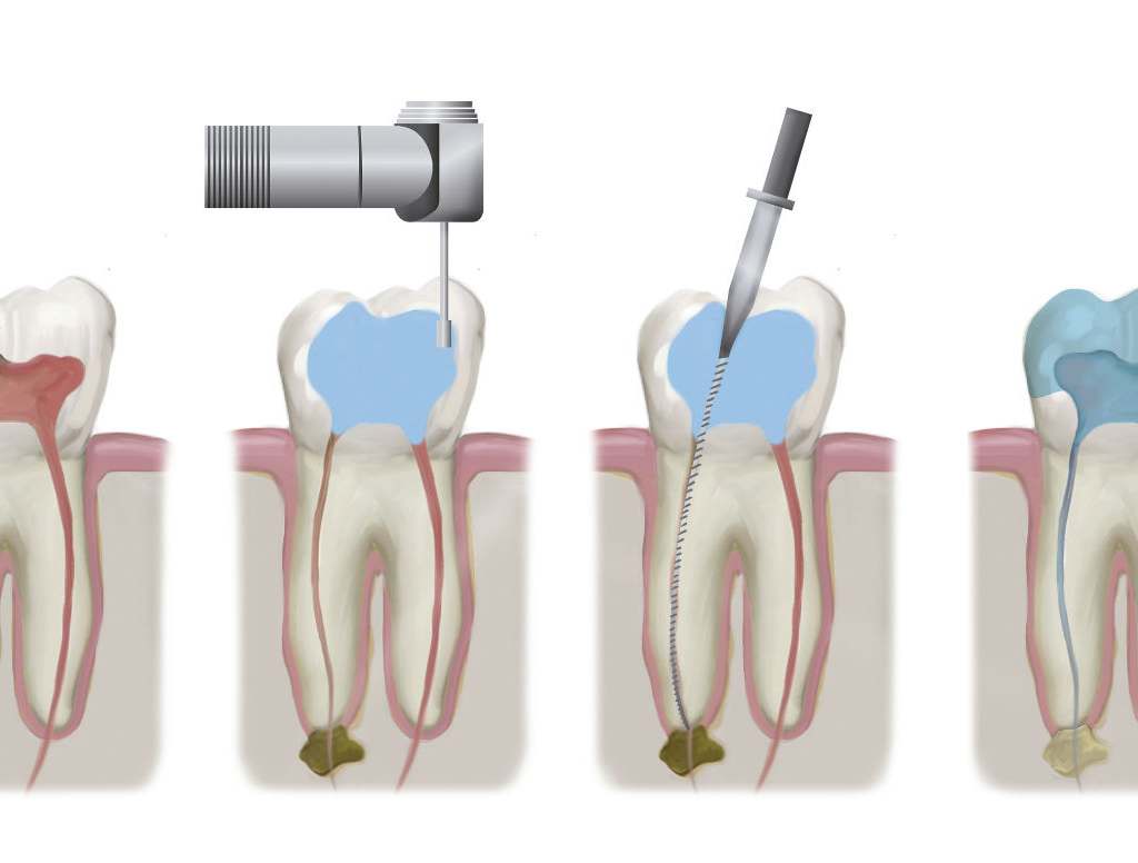 Временное пломбирование каналов лечебными пастами при наличии кист
