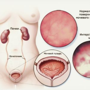 Воспаление мочевого пузыря